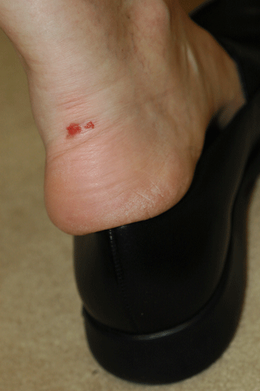 heel_slippage_blister.gif