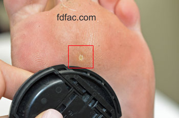 Worn_Shoe_Forefoot_Callous