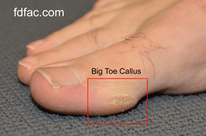 Blog_Hallux_Pinch_Callus_2